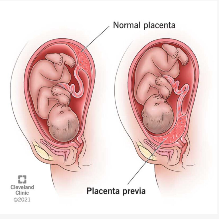 Placenta Previa? Here’s My Personal Placenta Previa Experience